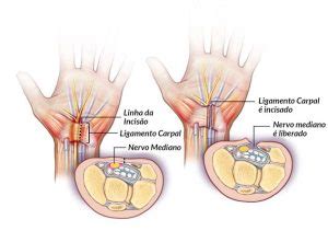 S Ndrome Do T Nel Do Carpo Diagn Stico E Tratamento Dr Pedro