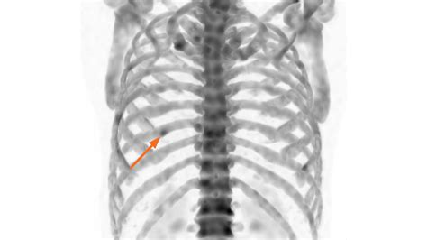 Differentiation Of A Rib Benign Lesion From A Metastasis Using XSPECT