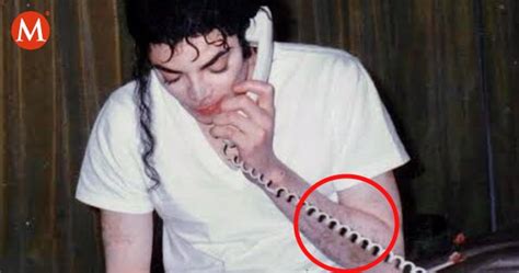 Vitiligo La Enfermedad Que Padec A Michael Jackson En Su Piel Y Caus