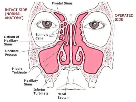 Complicated Functional Endoscopic Sinus Surgery Fess Dr Gerrie Moolman