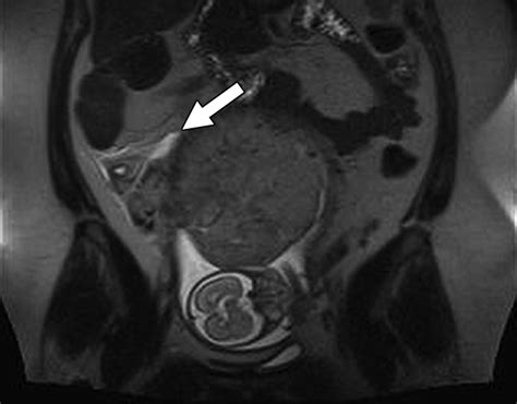 Contrast Enhanced Abdominal Mri For Suspected Appendicitis How We Do