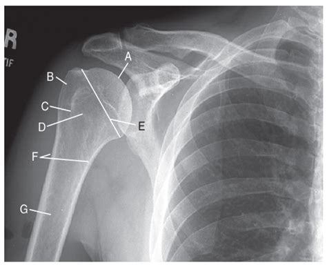 DIAGRAM AP External Rotation True AP Anatomy X Ray Diagram Quizlet