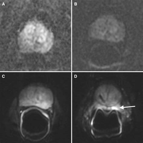 Prostate Mri Using An External Phased Array Wearable Pelvic Coil At 3t Comparison With An