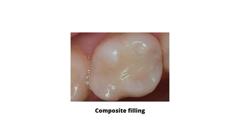 Your Guide To Back Tooth Cavity Filling Types Procedure And Aftercare