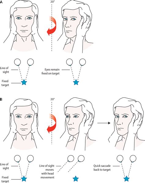 Vestibular Health What Is The VOR