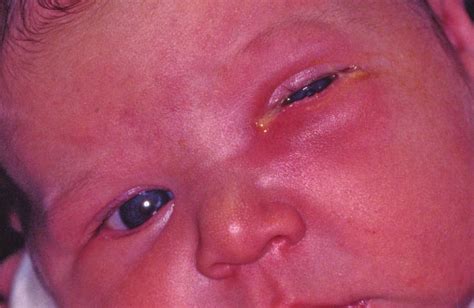 Study Medical Photos: Neonatal Conjunctivitis - A Brief Discussion