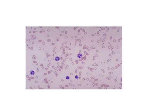Iron Deficiency Anemia And Its Lab Diagnosispptx