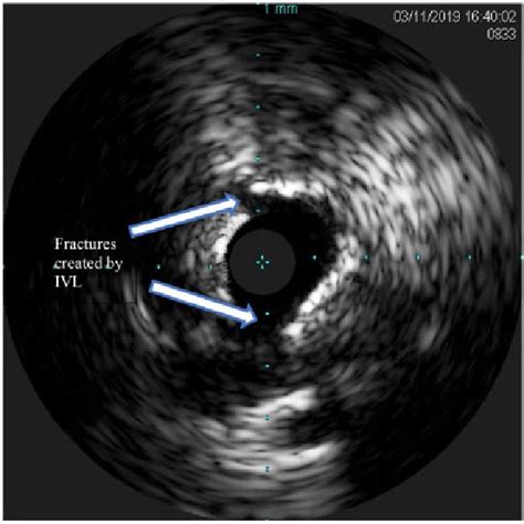 Case Ivus Post Ivl Ivus Intravascular Ultrasound Ivl