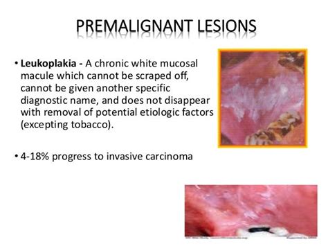 Carcinoma Buccal Mucosa Anatomy To Management