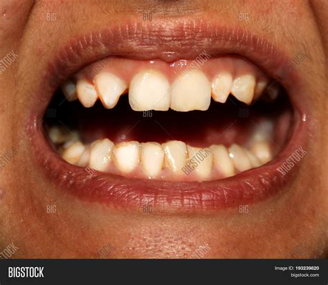 Crooked Teeth Image Photo Free Trial Bigstock