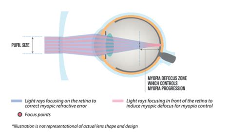 How Miyosmart Lenses Helps To Control Myopia Ojo Kaijoo