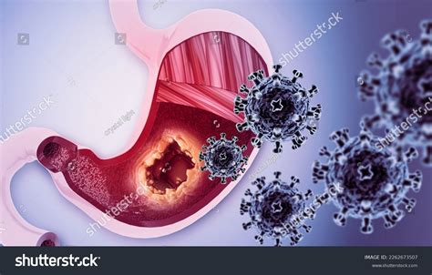 Stomach Cancer Gastric Cancer Symptoms Stages Stock Illustration 2262673507 Shutterstock