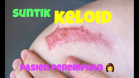 Cara Mengatasi Keloid Yang Gatal Dan Membesar Keloid YouTube