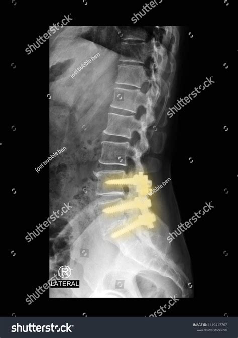 Film Xray Lumbar Spine Radiograph Showing Stock Photo (Edit Now) 1419417767