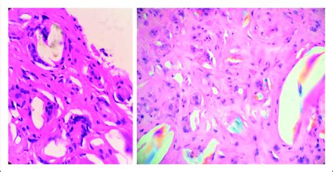 Histopathology Showing Significant Multinucleated Giant Cell Foreign