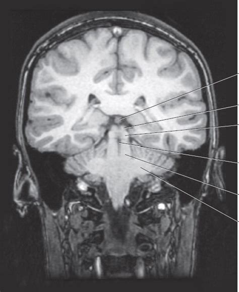 Labelling - Coronal MRI of the Midbrain Diagram | Quizlet