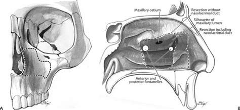 Maxillary Sinus Medial Wall