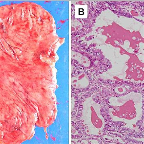 Resected Specimen Findings The Tumor Is A Type I Lesion 25×20 Mm In Download Scientific