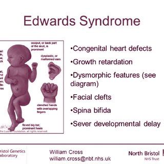 Edwards Syndrome Telegraph