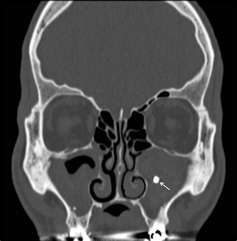 Unusual Case Of Bilateral Maxillary Fungus Ball Bmj Case Reports