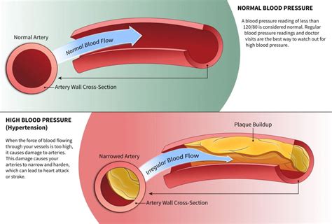 High Blood Pressure and Erectile Dysfunction | Department of Surgery ...