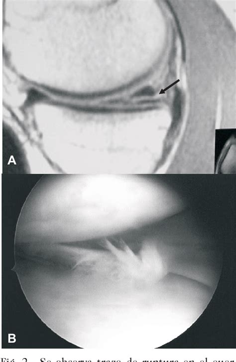 Figure From Evaluaci N De La Morfolog A Meniscal Y Relaci N Entre Los