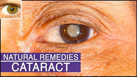 Very Simple Natural Remedy That Reduces Cataract Improves The Vision