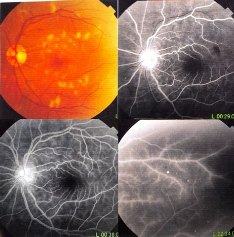 Fundus Photography And Fluorescein Angiography Os Showing Posterior