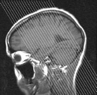 Brain Mri: Epilepsy Protocol Brain Mri