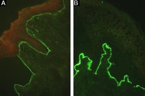 SciELO Brasil Epidermolysis Bullosa Acquisita Epidermolysis Bullosa