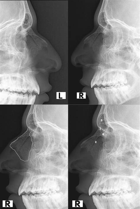 GÃy XƯƠng ChÍnh MŨi Nasal Bone Fracture Radiology ChẨn ĐoÁn HÌnh Ảnh