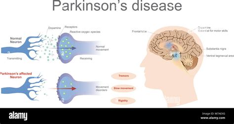 Les Niveaux De Dopamine De Manière Normale Et Un Neurone Affecté De Parkinson L Art Graphique