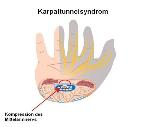 Karpaltunnelsyndrom Symptome Operation Schiene Test Handgelenk