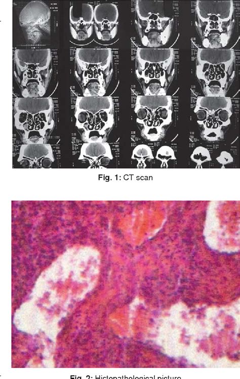 Figure 1 from Lobular Capillary Hemangioma of Nasal Cavity | Semantic Scholar