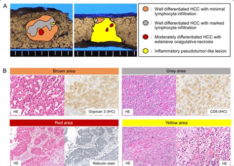 Illustrative presentation and histology of the tumor. The areas colored ...