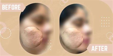 Open Pore Treatment In South Delhi Saket Skinqure