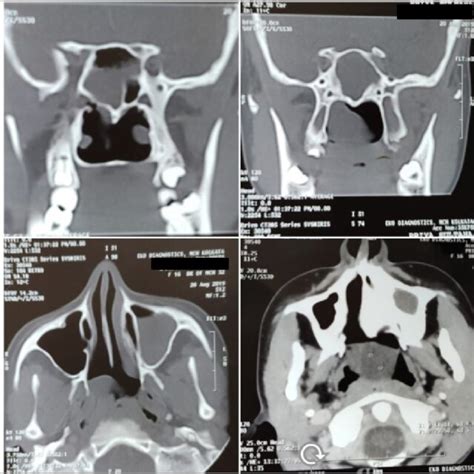 Ct Scan Showing Sphenochoanal Polyp Involving The Sphenoid Sinus And