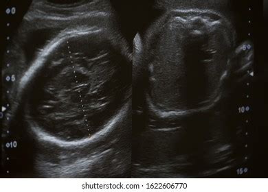 Ultrasound Baby Mothers Womb Stock Photo Shutterstock