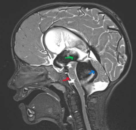 T2 sagittal MRI imaging of Case 1 shows a normal position of the ...