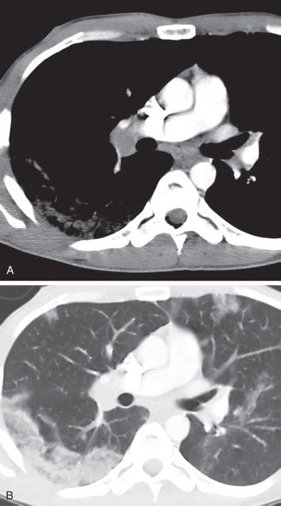 Eosinophilic Lung Diseases Radiology Key