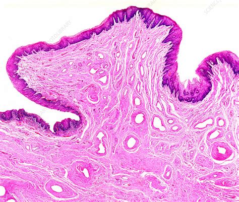 Severe Cervical Dysplasia Light Micrograph Stock Image C052 2702