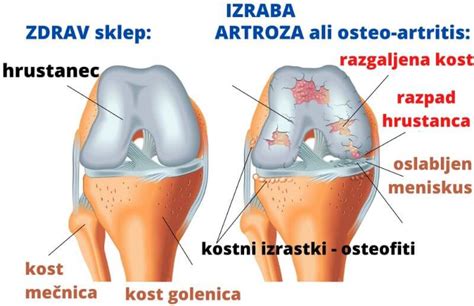 Hrustanec Se V Sklepih Izrabi Pri Artrozi Ali Osteo Artritisu ALKIVITA