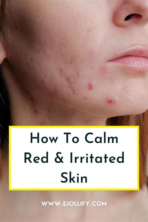 How To Calm Irritated Skin • Treat And Soothe Irritated Face Itchy Skin