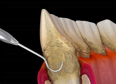 Deep Cleaning Teeth With Scaling And Root Planing IMPLANT PERIO CENTER