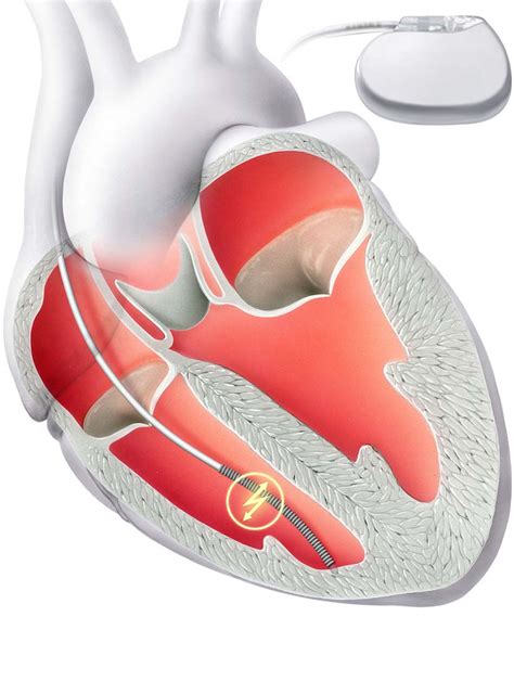 Sottoveste Preda Operazione Defibrillatore Cardiaco Interno