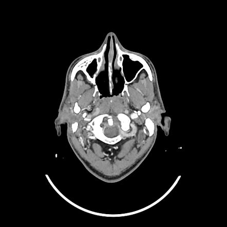 Maxillary odontogenic keratocyst | Radiology Case | Radiopaedia.org