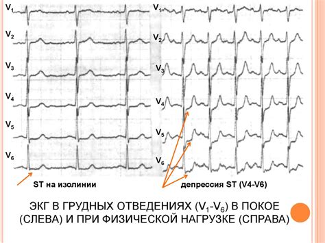 Ишемическая болезнь сердца. Стенокардия - презентация онлайн