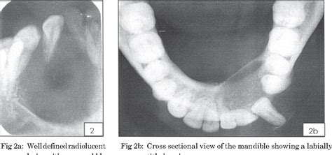 Figure 2 From Adenomatoid Odontogenic Tumor Of The Mandible