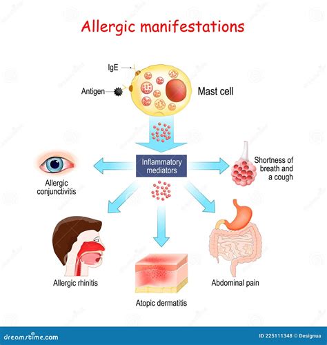 Food Allergy And Allergic Manifestations Mast Cell Stock Vector