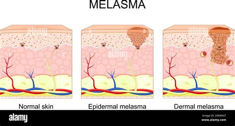 Melasma Types Of Chloasma Faciei Cross Section Of Human Skin With